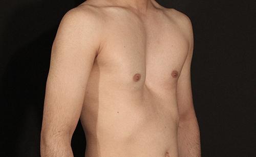 PECTUS EXCAVATUM