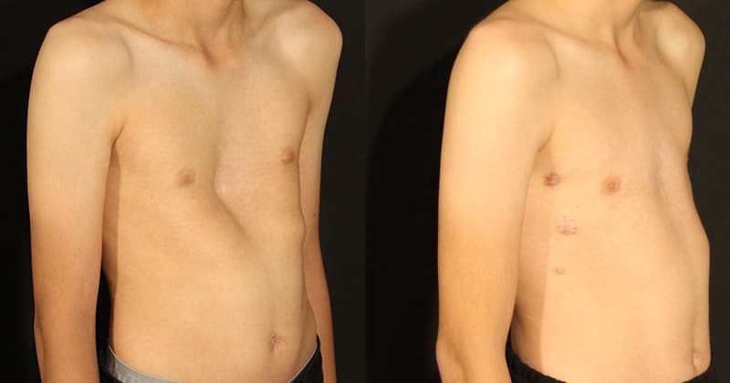 Pectus Excavatum Nuss Surgery