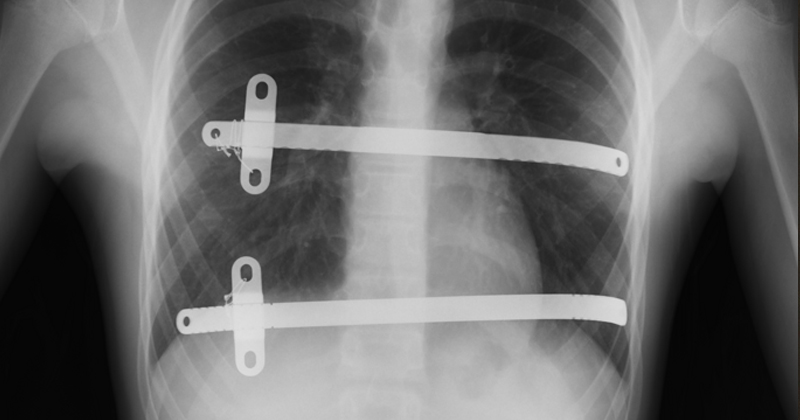 Pectus Excat Pectus Excavatum X Ray Measurement